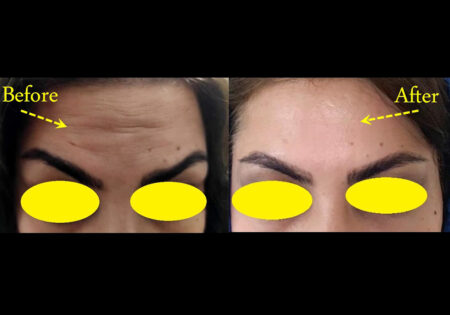 Botox-Nemonekar-Img
