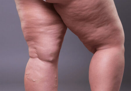 Lipo-Ran-Img