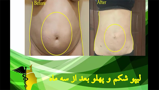 نمونه عمل لیپوماتیک