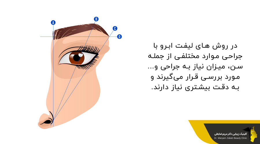 جراحی لیفت ابرو