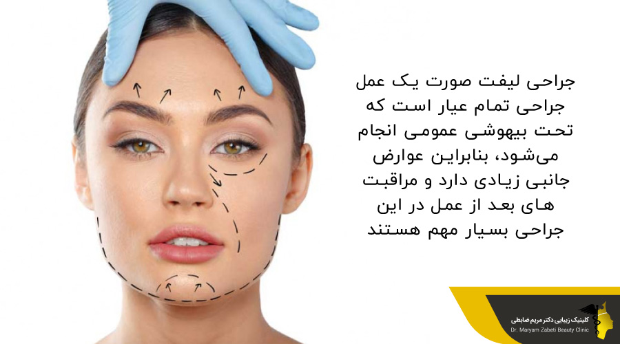 خطوط لیفت بر روی صورت