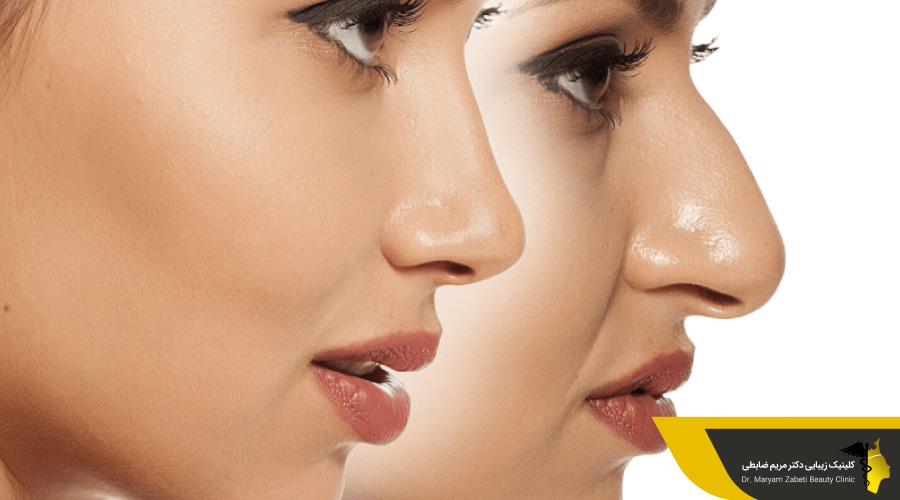 نمونه قبل و بعد از لیفت بینی