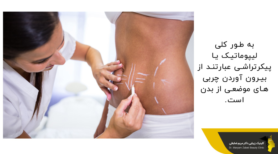انجام عمل لیپوماتیک