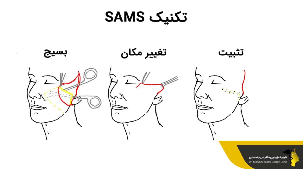 تکنیک SMAS