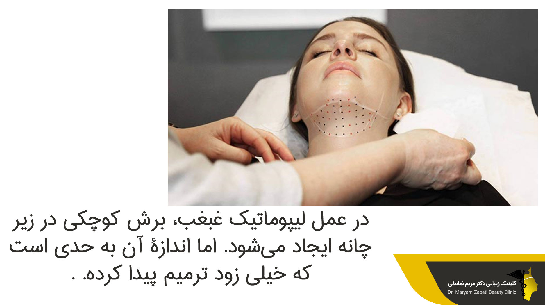 تأثیر تخلیه چربی غبغب در چهره