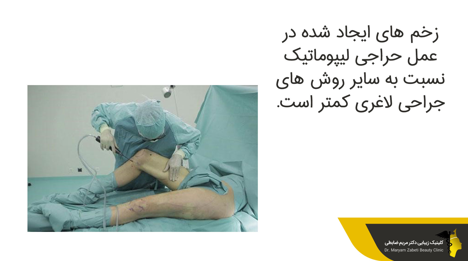 میزان جای بعد از عمل لیپوماتیک