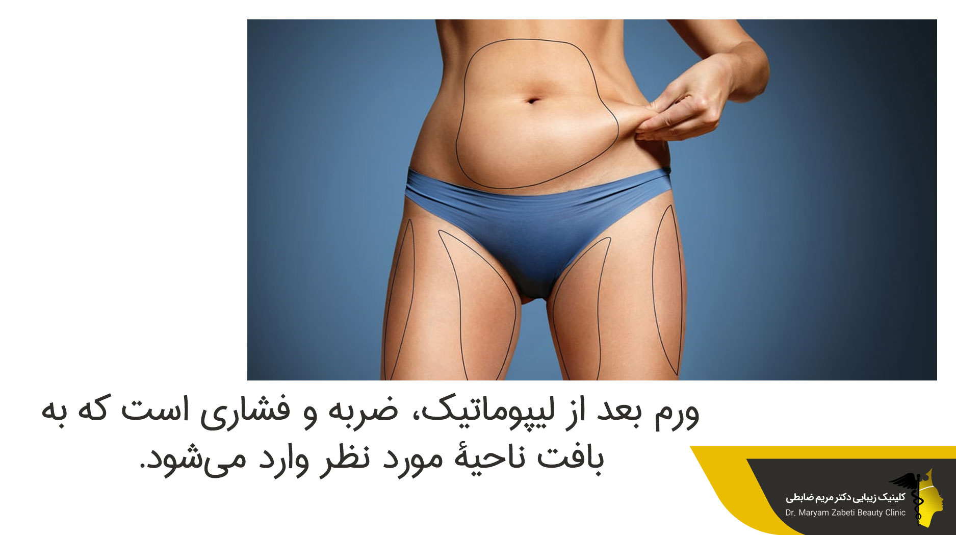  دلایل ورم بعد از لیپوماتیک
