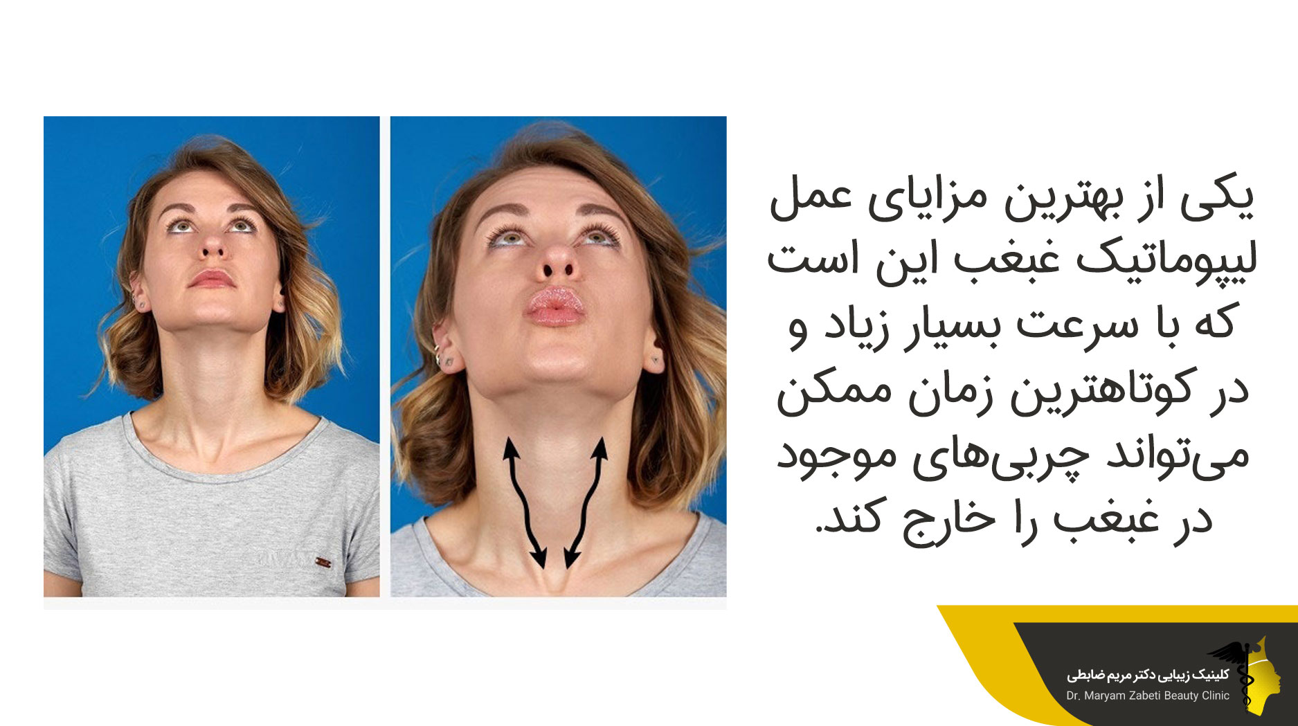 مزایای عمل لیپوماتیک غبغب