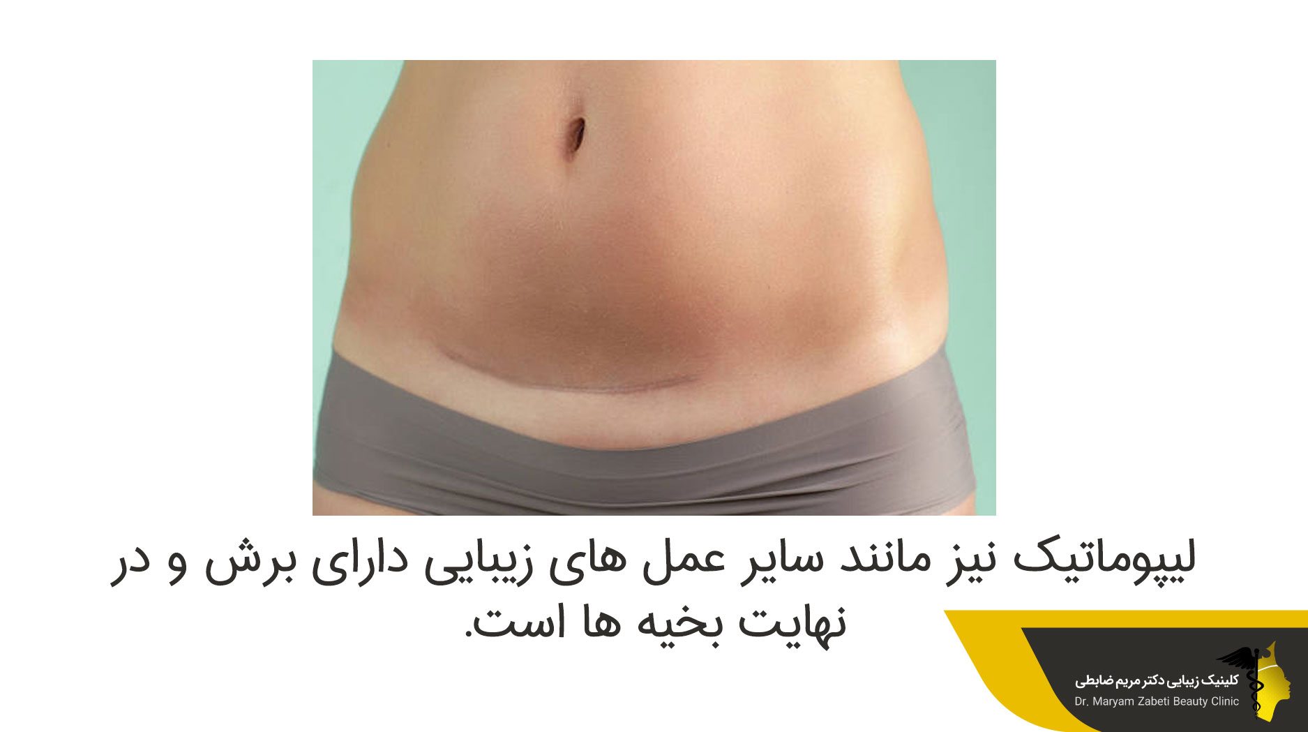 ماندگاری جای زخم در لیپوماتیک