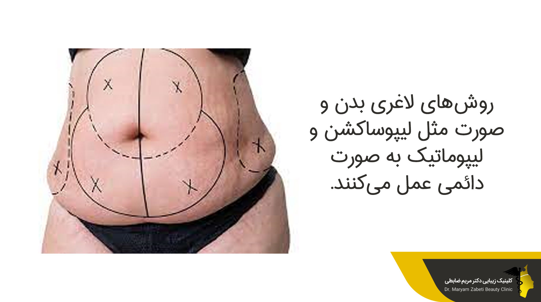 بازگشت چاقی بعد از لیپوماتیک
