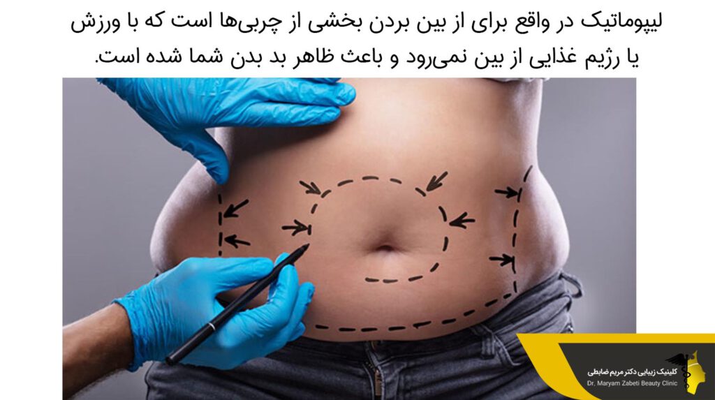 لیپوماتیک و از بین بردن چربی ها