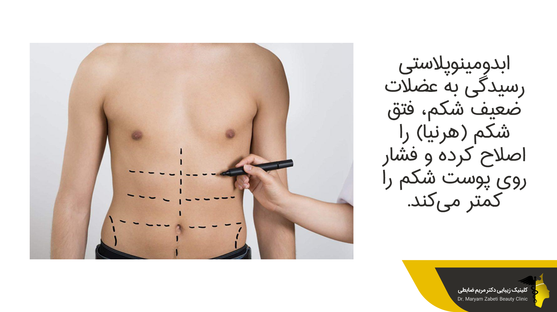 مزایا و معایب ابدومینوپلاستی و لیپوماتیک