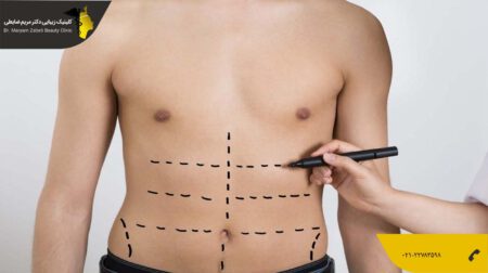 shakheslipo کاهش وزن بعد از لیپوماتیک