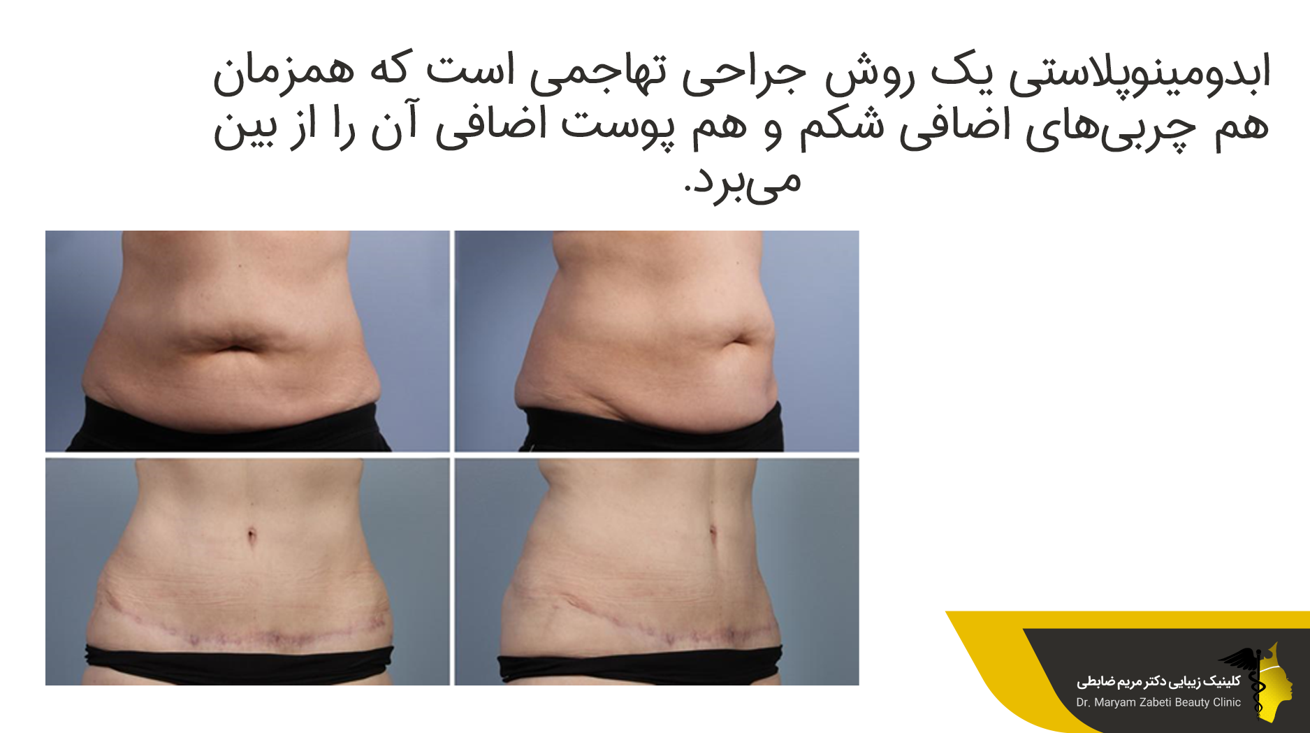 تفاوت لیپوماتیک با ابدومینوپلاستی 