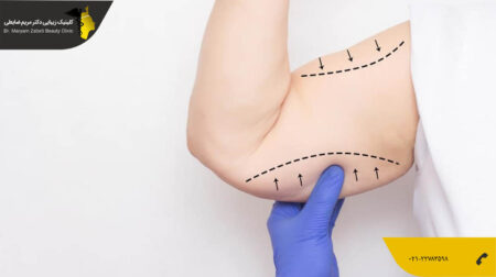 shakheslipo صفر تا صد لیپوماتیک بازو