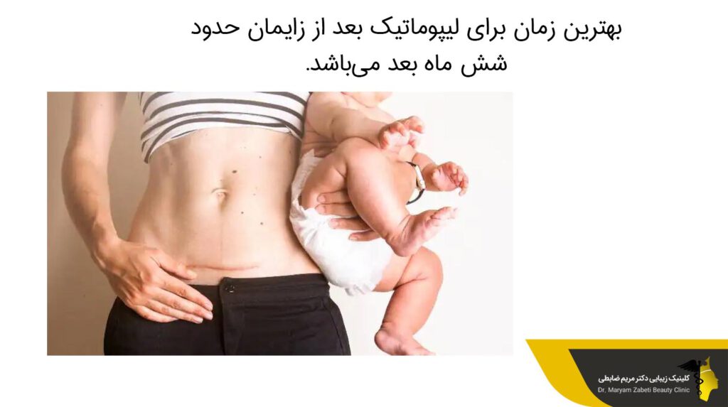 بهترین زمان برای لیپوماتیک بعد از زایمان