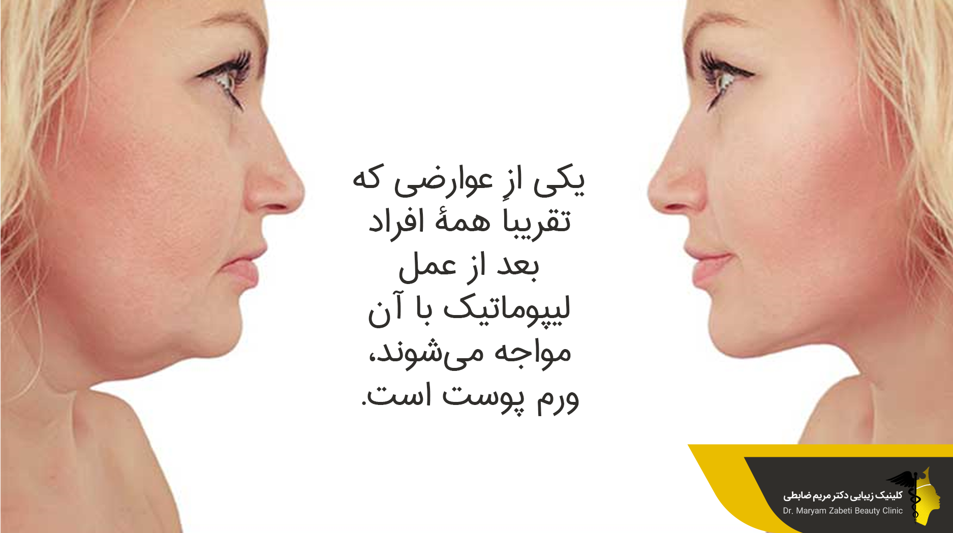  عوارض بر طرف کردن غبغب 