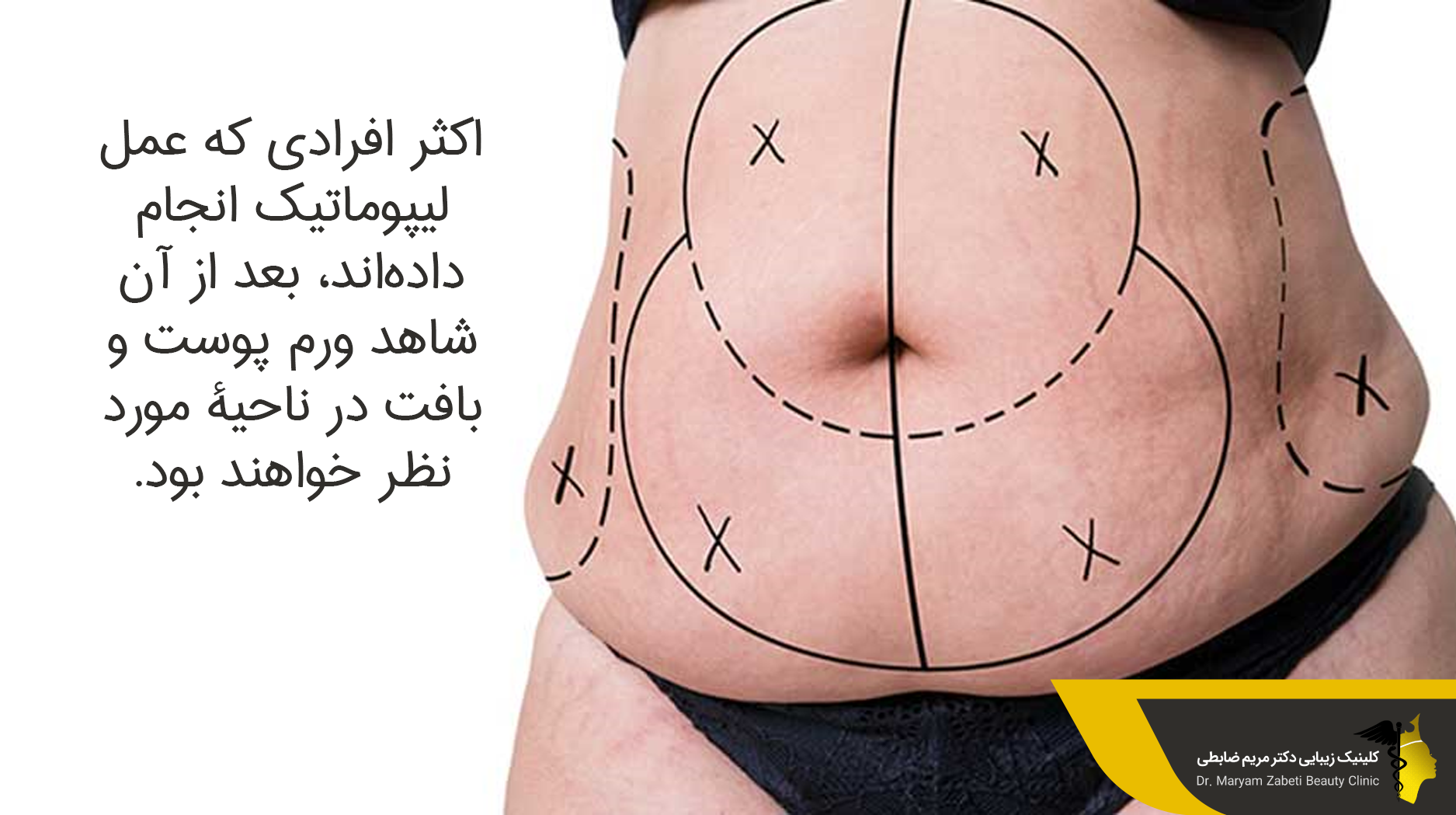  کاهش ورم بعد از لیپوماتیک