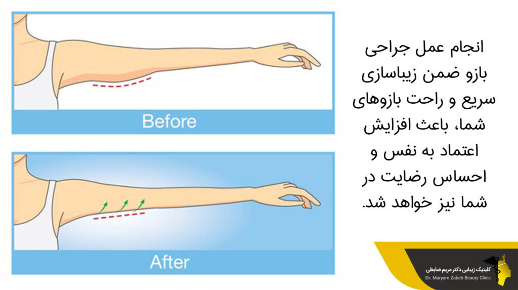 انجام عمل جراحی بازو