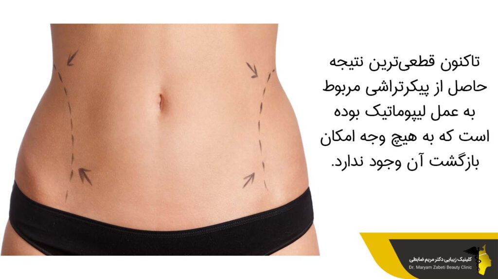 قطعی‌ترین نتیجه حاصل از پیکرتراشی مربوط به عمل لیپوماتیک بوده است 