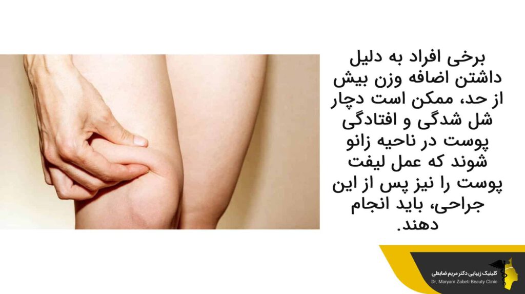 شل شدگی و افتادگی پوست در ناحیه زانو 