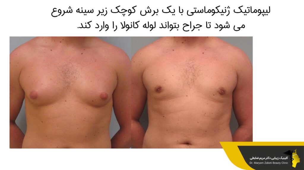 لیپوماتیک ژنیکوماستی 