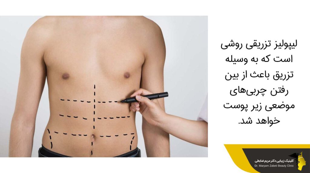 لیپولیز تزریقی 