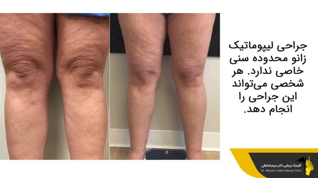 جراحی لیپوماتیک زانو محدوده سنی خاصی ندارد