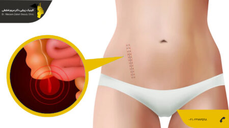 dr.zabeti جای زخم عمل لیپوماتیک
