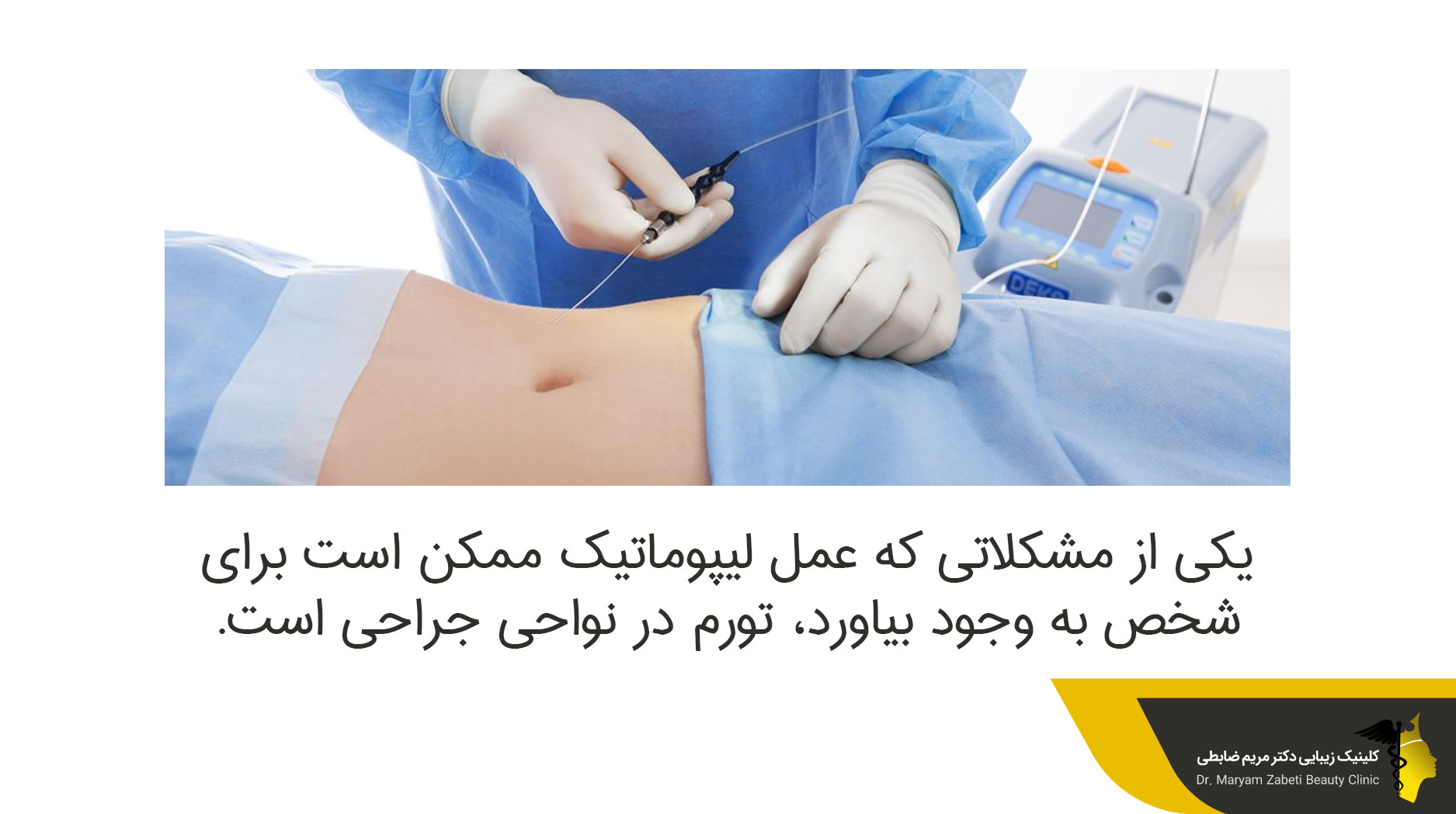 معایب لیپوماتیک