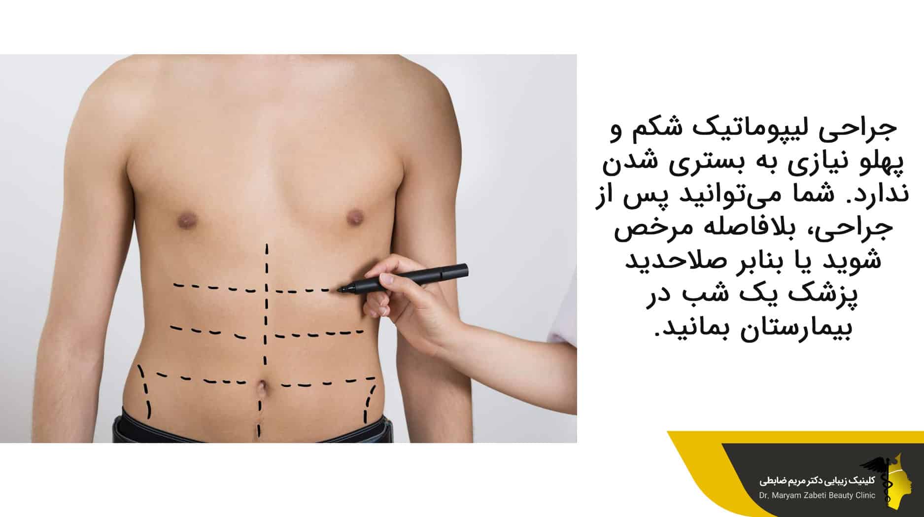 جراحی لیپوماتیک شکم و پهلو نیازی به بستری شدن ندارد. 