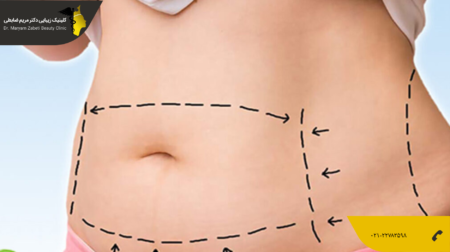 shakheslipo عمل لیپوماتیک یا ابدومینوپلاستی
