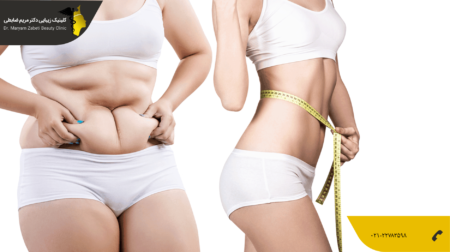 shakheslipo افتادگی پوست بعد از لیپوماتیک