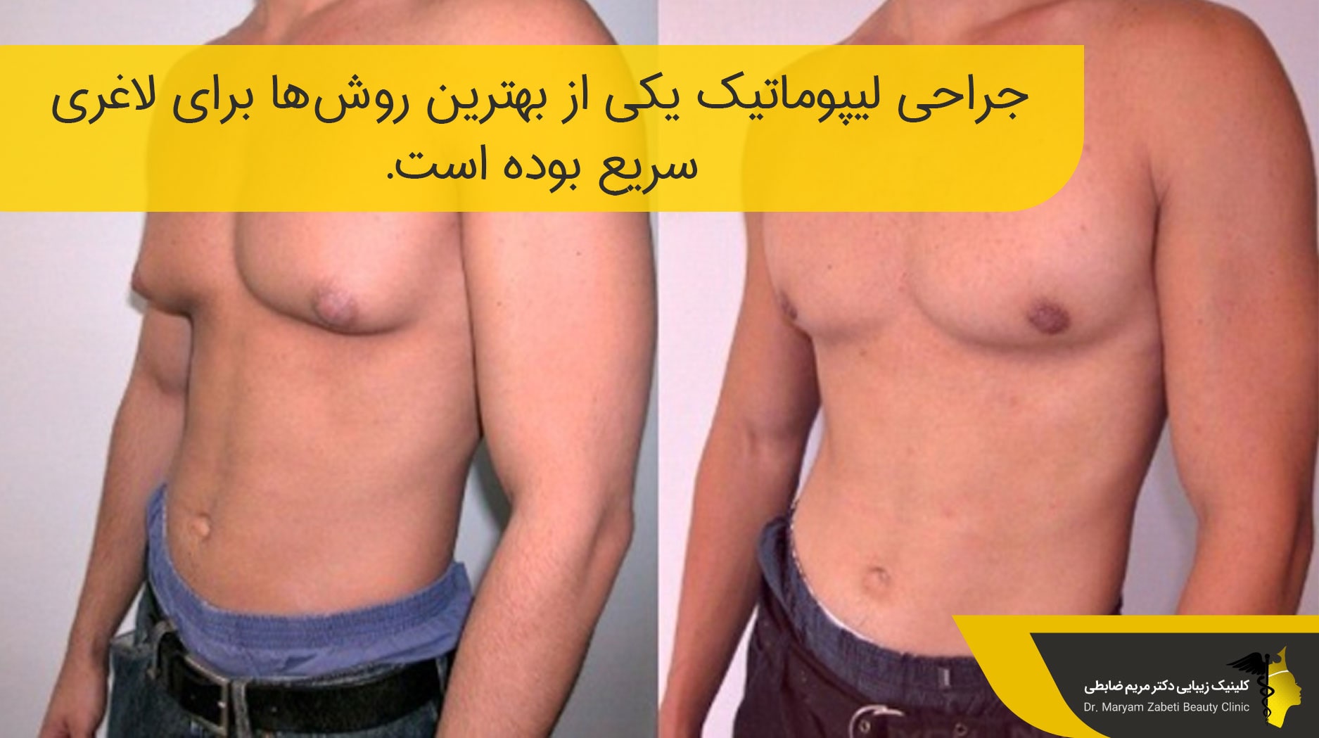 انجام لیپوماتیک آقایان