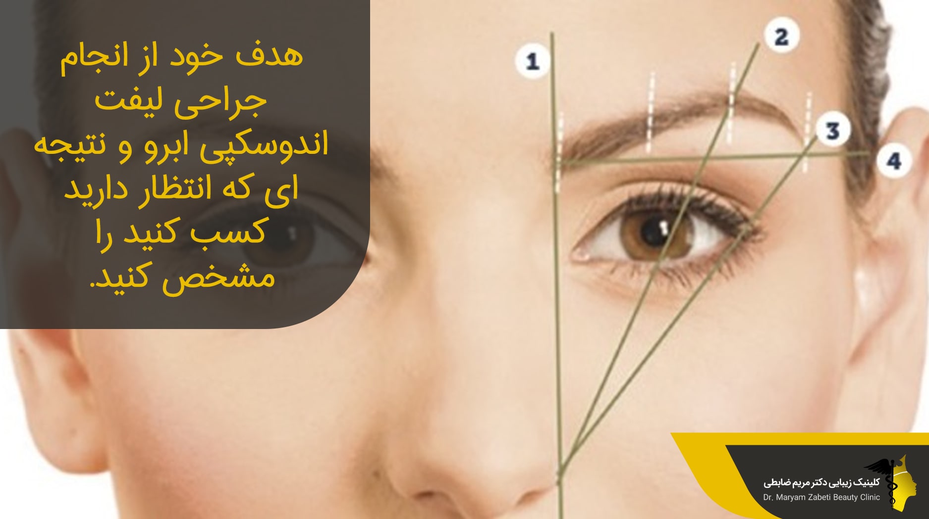 انجام لیفت ابرو اندوسکوپیک