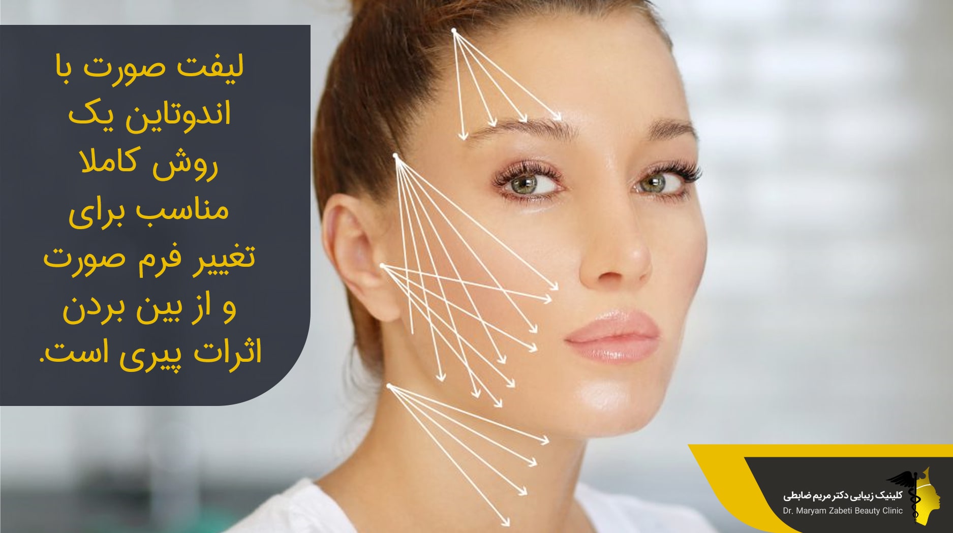 روش لیفت اندوتاین