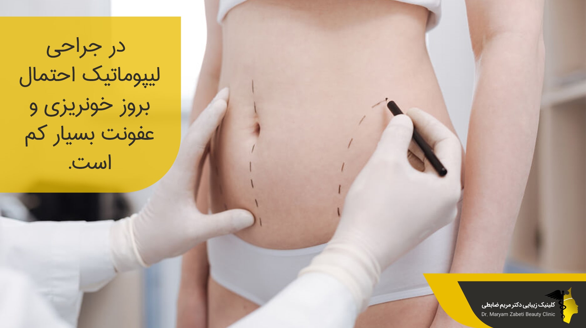 مزایای عمل لیپوماتیک
