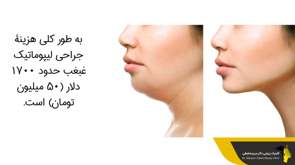لیپوماتیک غبغب