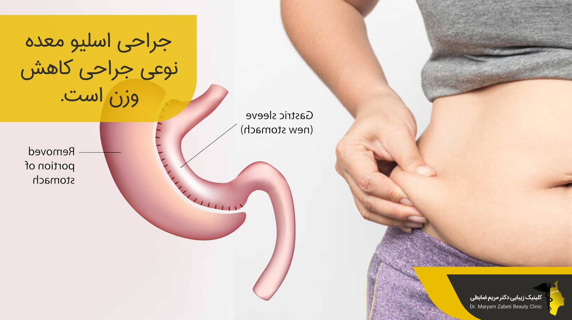 جراحی اسلیو معده