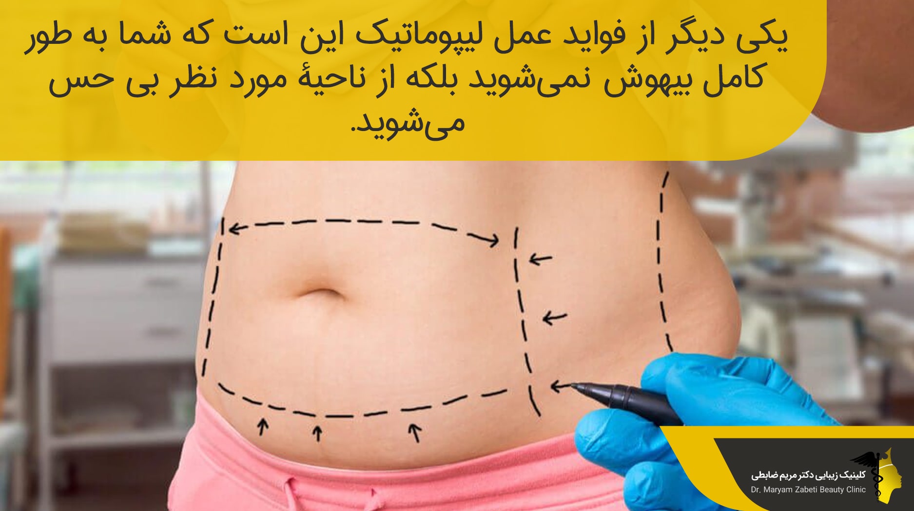 مزایای لیپوماتیک