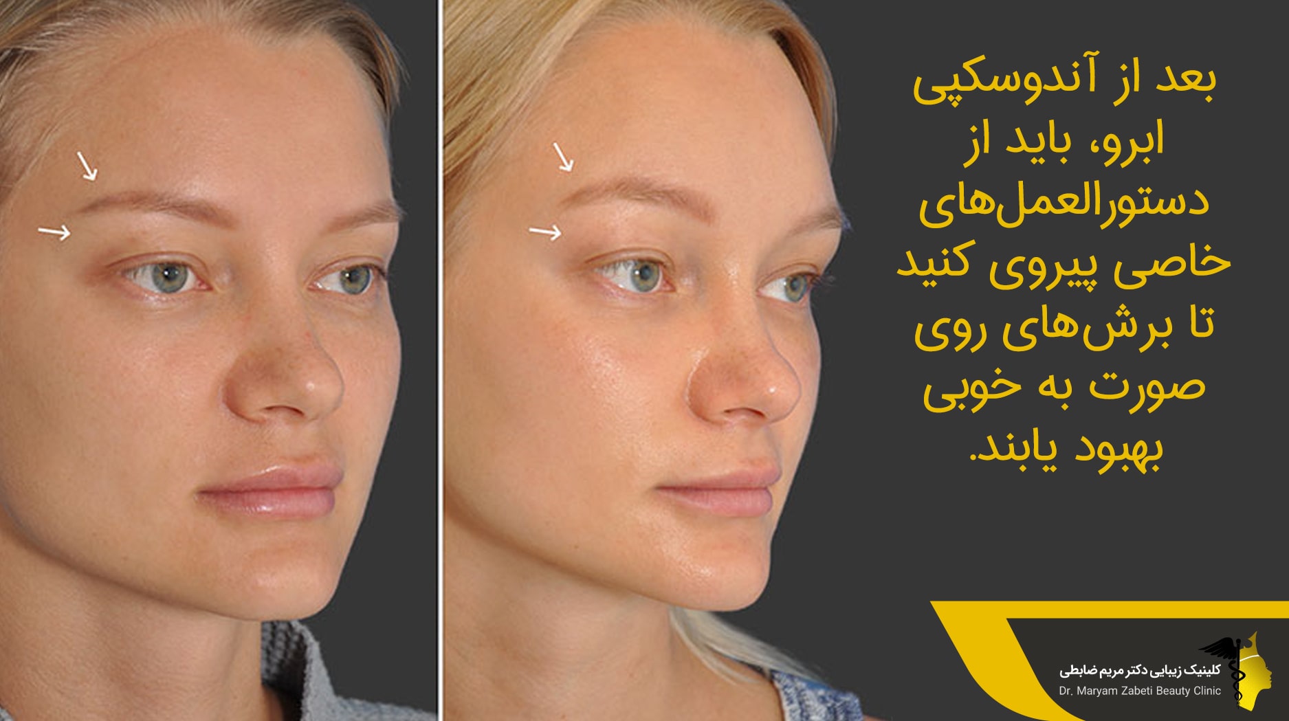 مراقبت بعد از لیفت ابرو با آندوسکپی