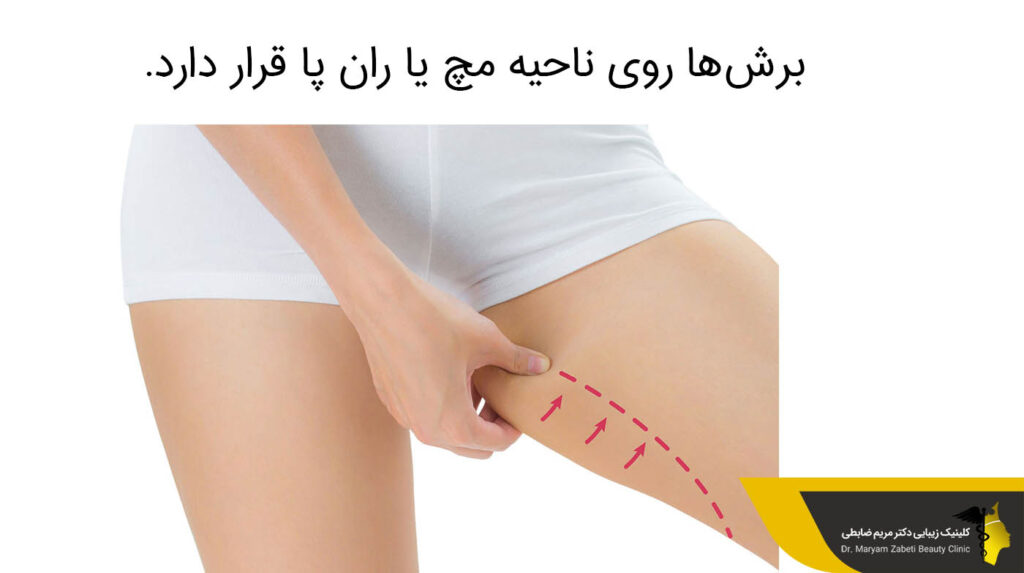 برش‌ها برای لیپو ساق پا، روی ناحیه مچ یا ران پا قرار دارد.