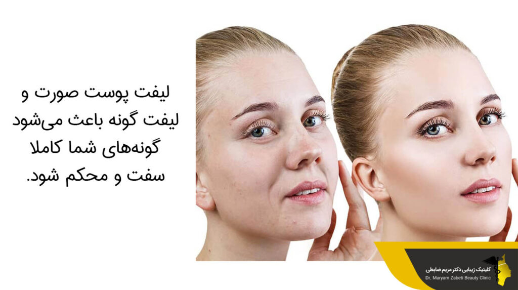 لیفت پوست صورت و لیفت گونه 