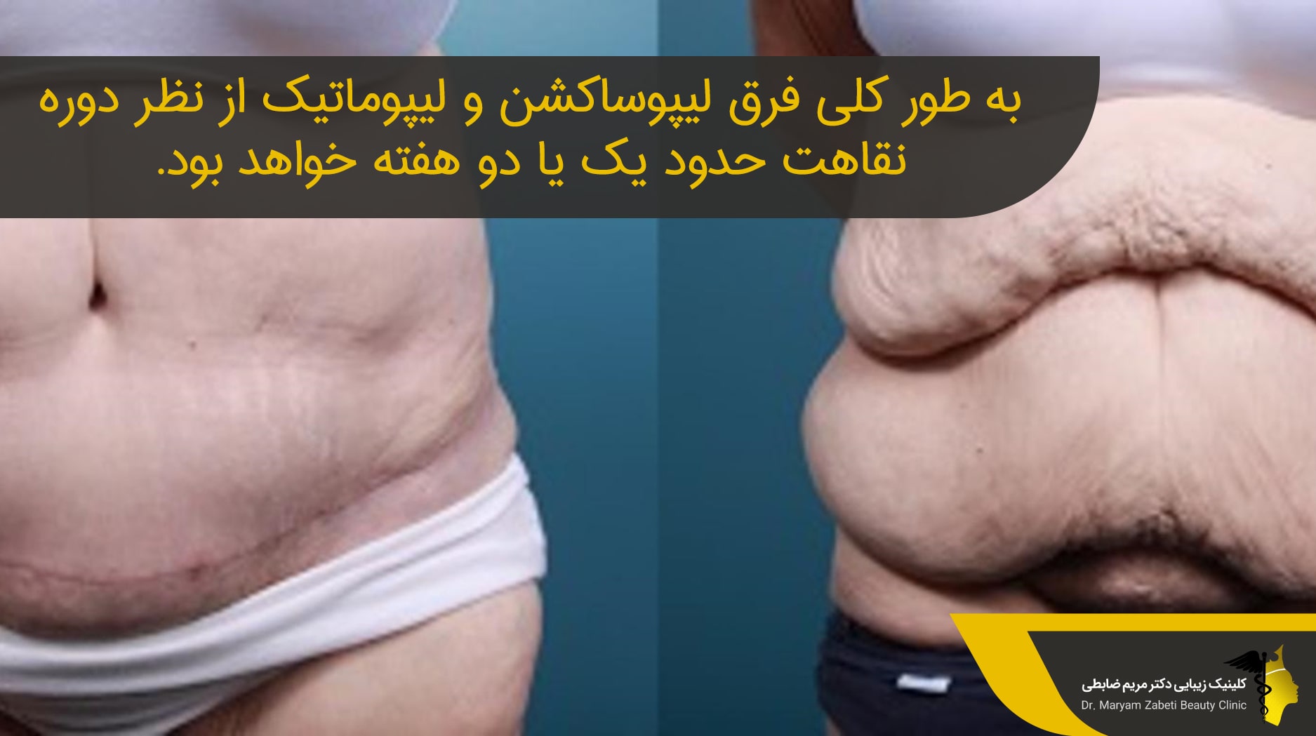 بررسی تفاوت لیپوساکشن با لیپوماتیک