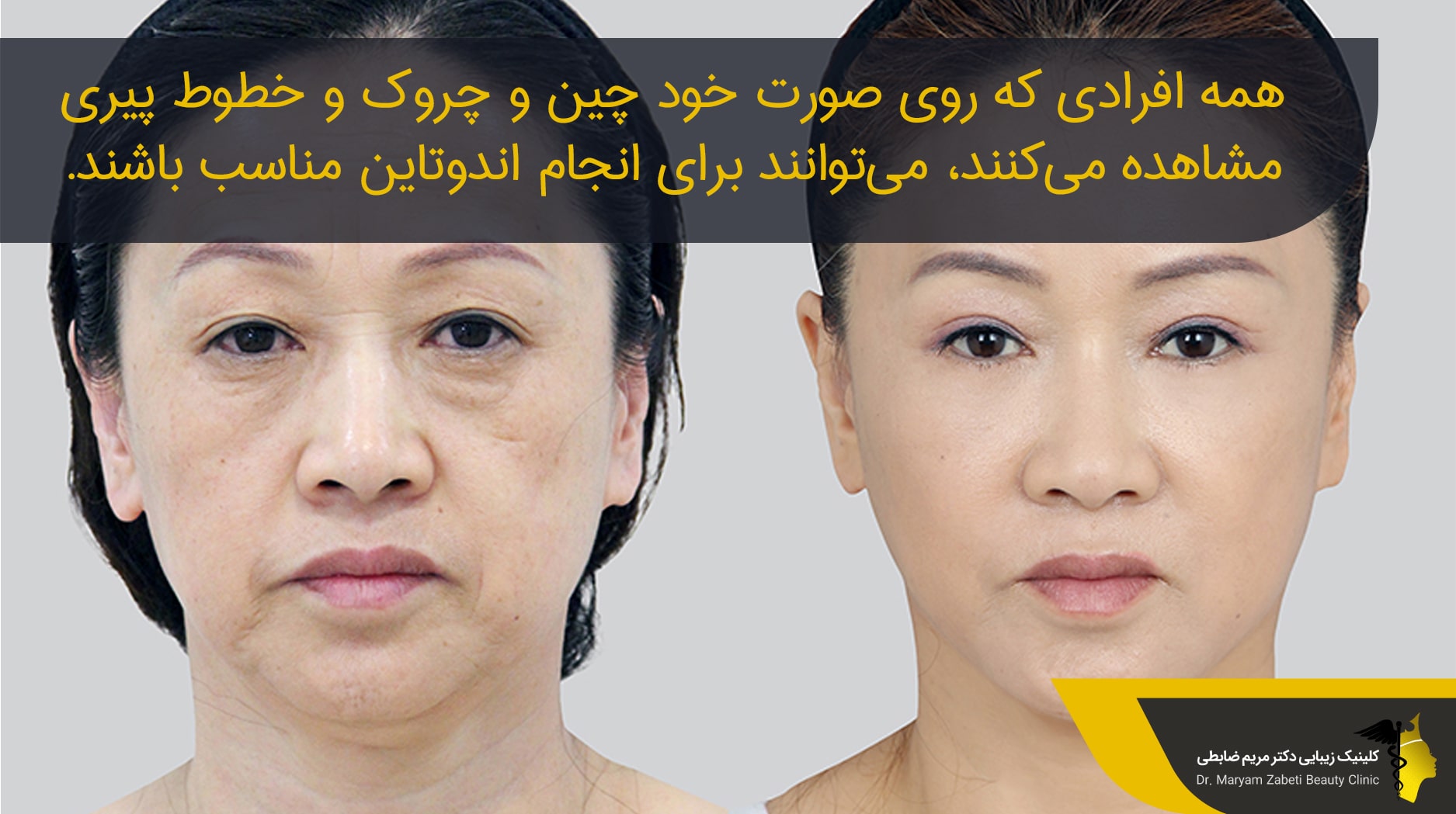 افرادی برای انجام اندوتاین مناسب هستند