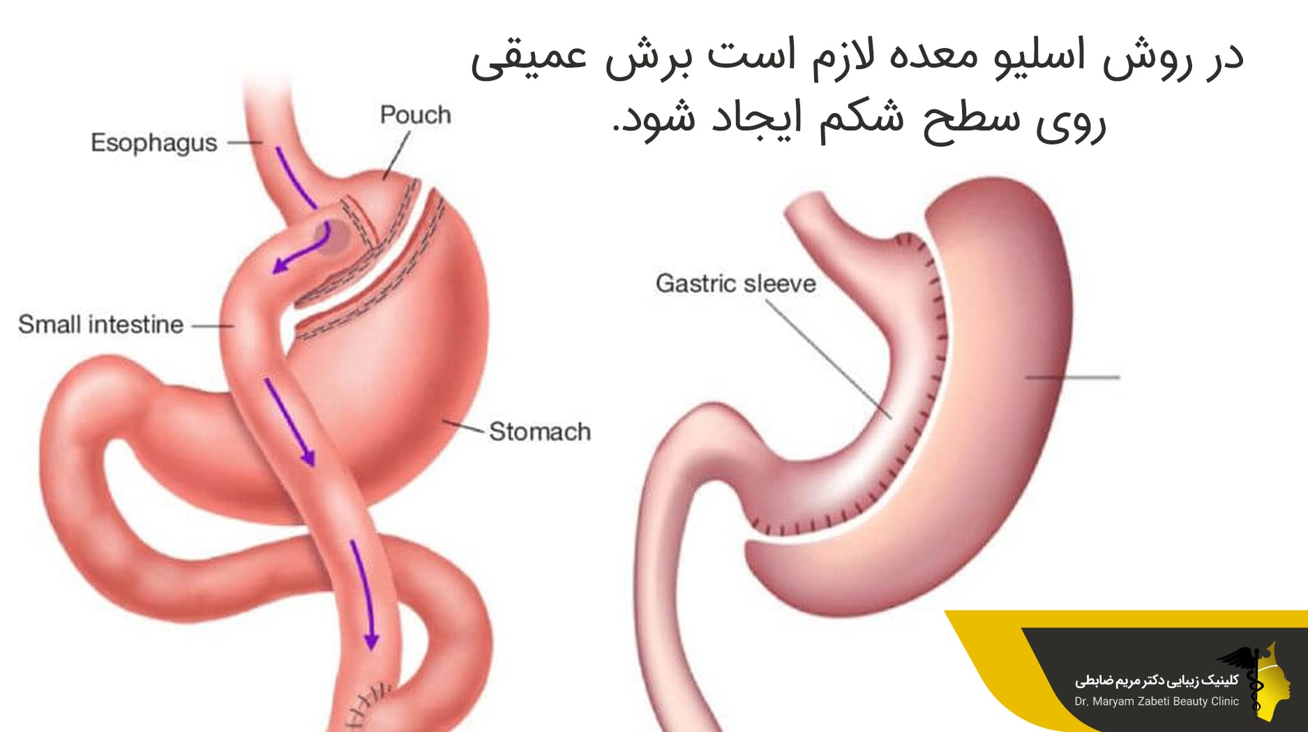 جراحی اسلیو معده یا لیپوماتیک 