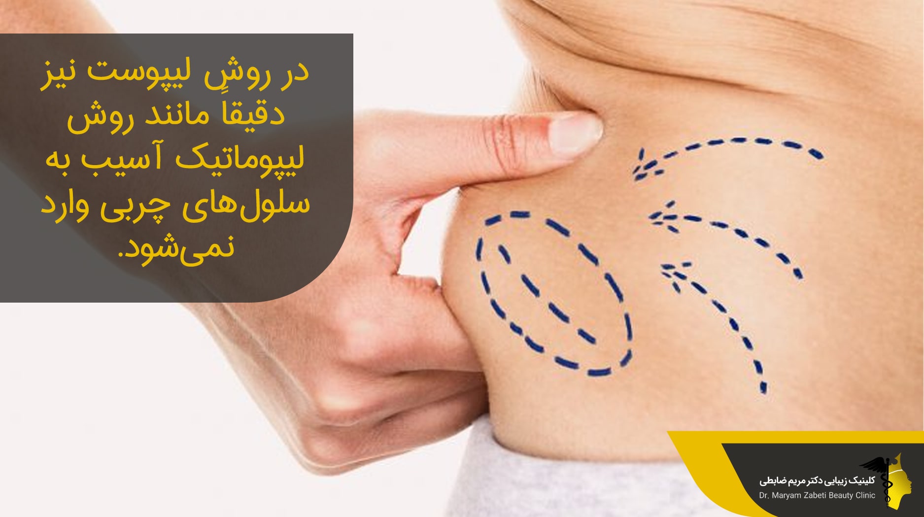 مزایای روش لیپوست