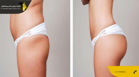 shakheslipo لیپوماتیک باسن