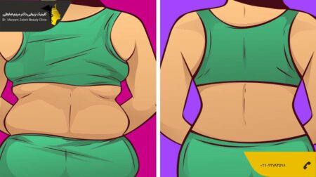 shakheslipo لیپوماتیک پشت و تخلیه چربی پشته کمر و کتف