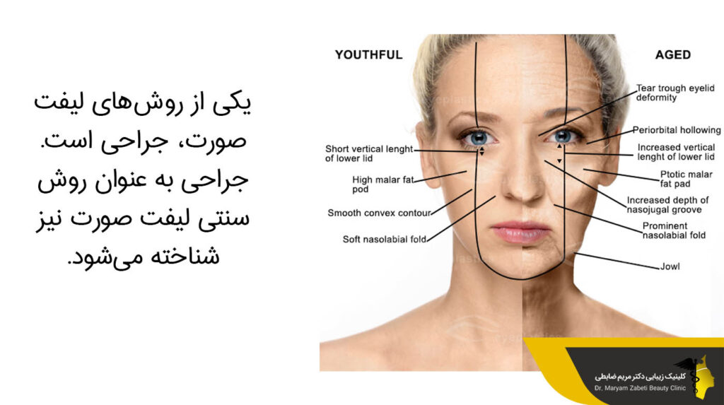 روش سنتی لیفت صورت 